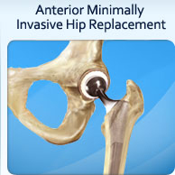 Anterior Minimally Invasive Hip Replacement - Peak Orthopedics & Spine
