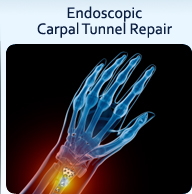Endoscopic Carpal Tunnel Repair - Peak Orthopedics & Spine